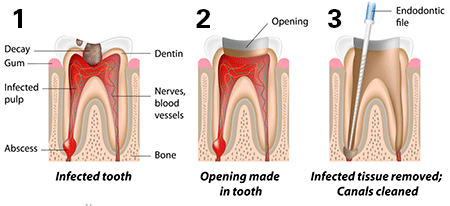 root canal treatment maroubra
