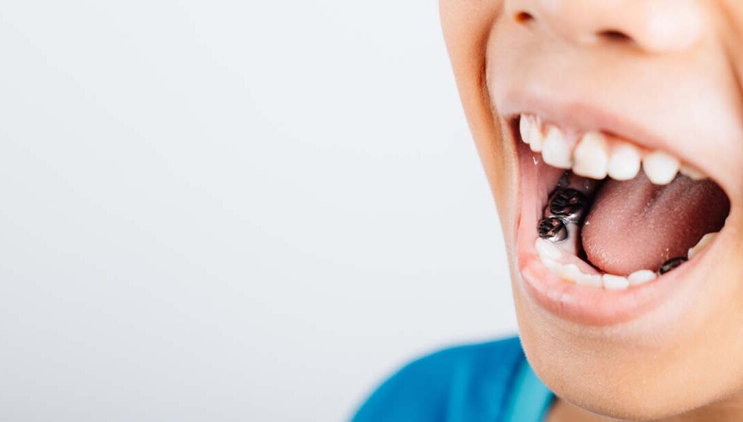 Amalgam fillings aren’t actually bad for your health