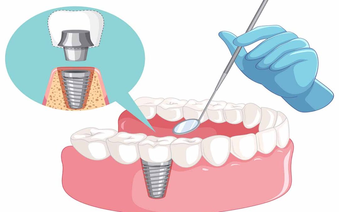 The Low Down on Single Tooth Crowns