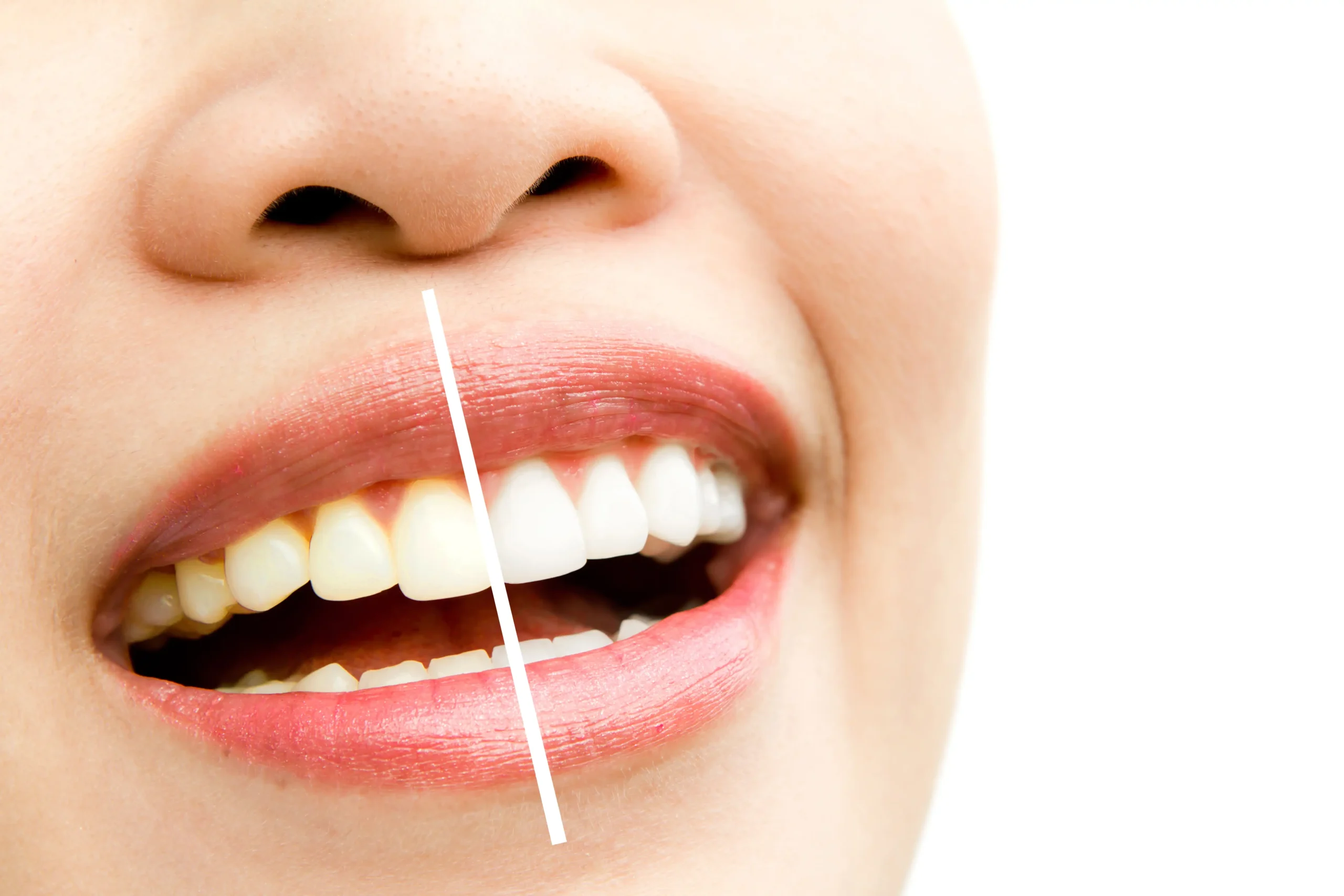Close-up of a smiling person's teeth with a before-and-after teeth whitening comparison, showing stained yellow teeth on one side and bright white teeth on the other.