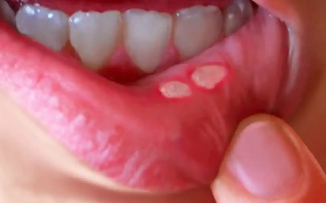 Mouth Ulcers: Why Do They Keep Popping Up and How Can You Actually Get Rid of Them?