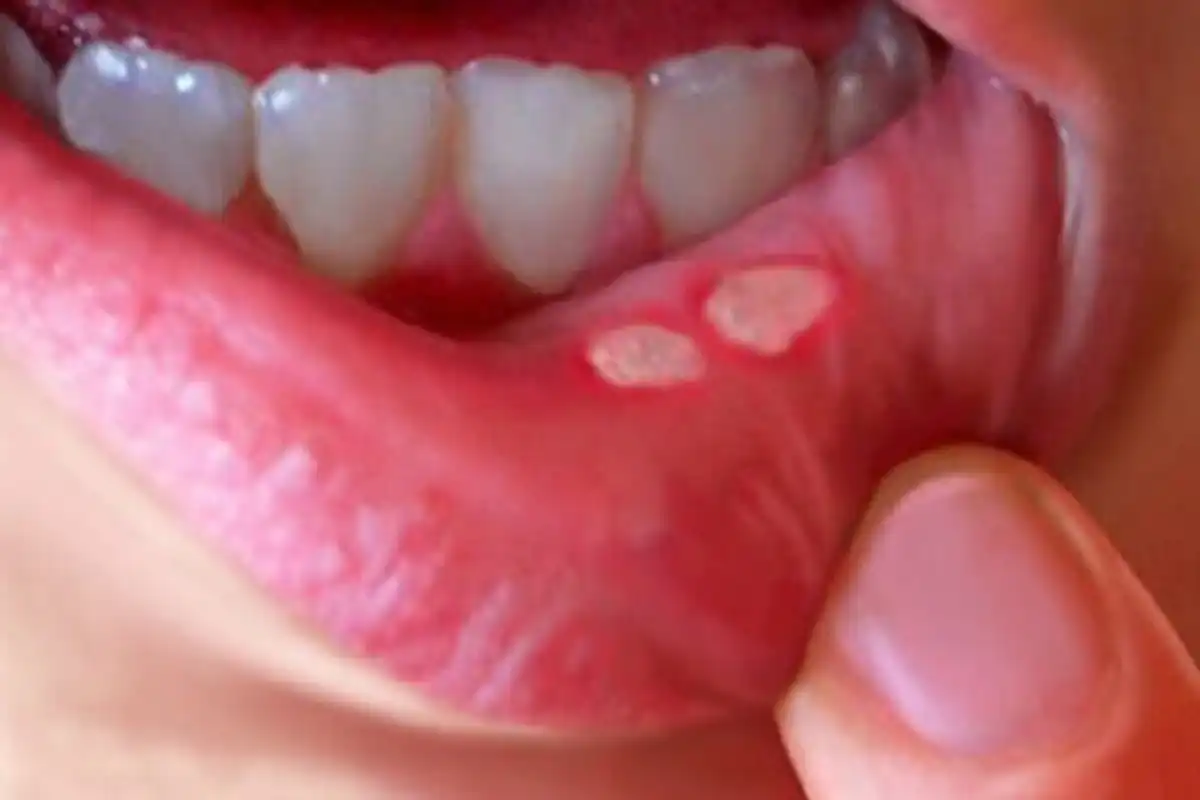 dentitst 1 Small sores on the inside of the lower lip near the teeth