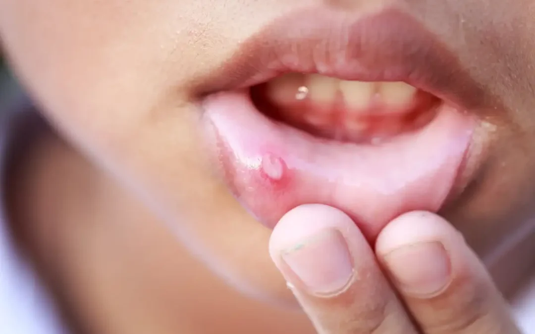 Mouth Ulcers: Why Do They Keep Popping Up and How Can You Actually Get Rid of Them?