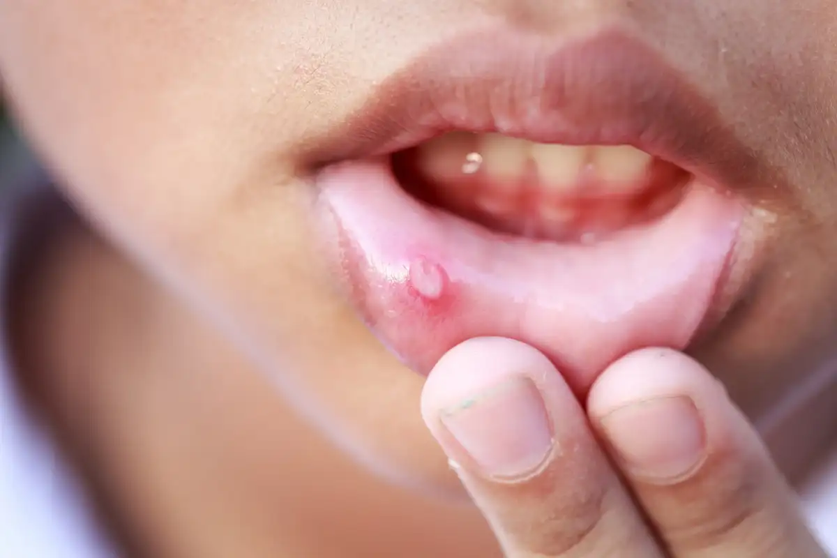 Mouth Ulcers: Why Do They Keep Popping Up and How Can You Actually Get Rid of Them?